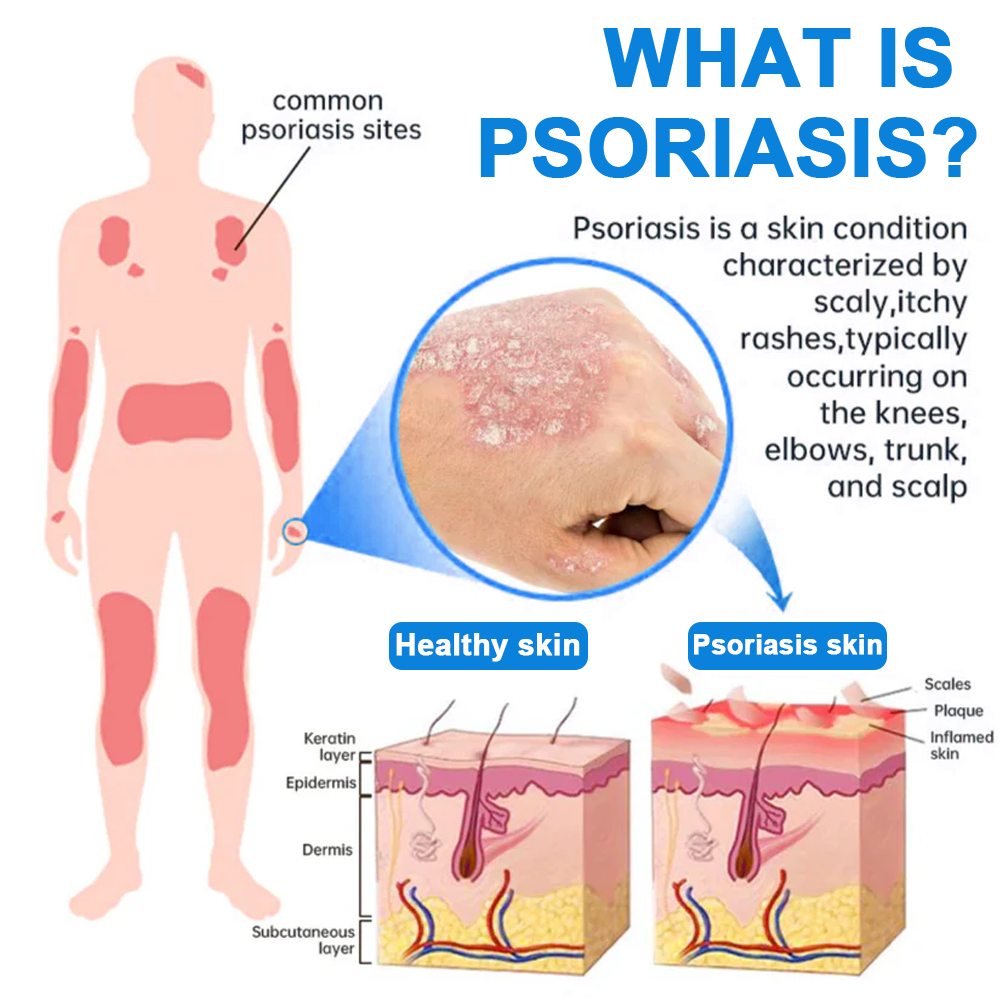 ✅ Official Store: Cvreoz® Magnesium Herbal Psoriasis Spray 👨‍⚕️ MHRA Approved (Relieves psoriasis and eczema, improves bacterial infections in the genital area, treats acne and warts)