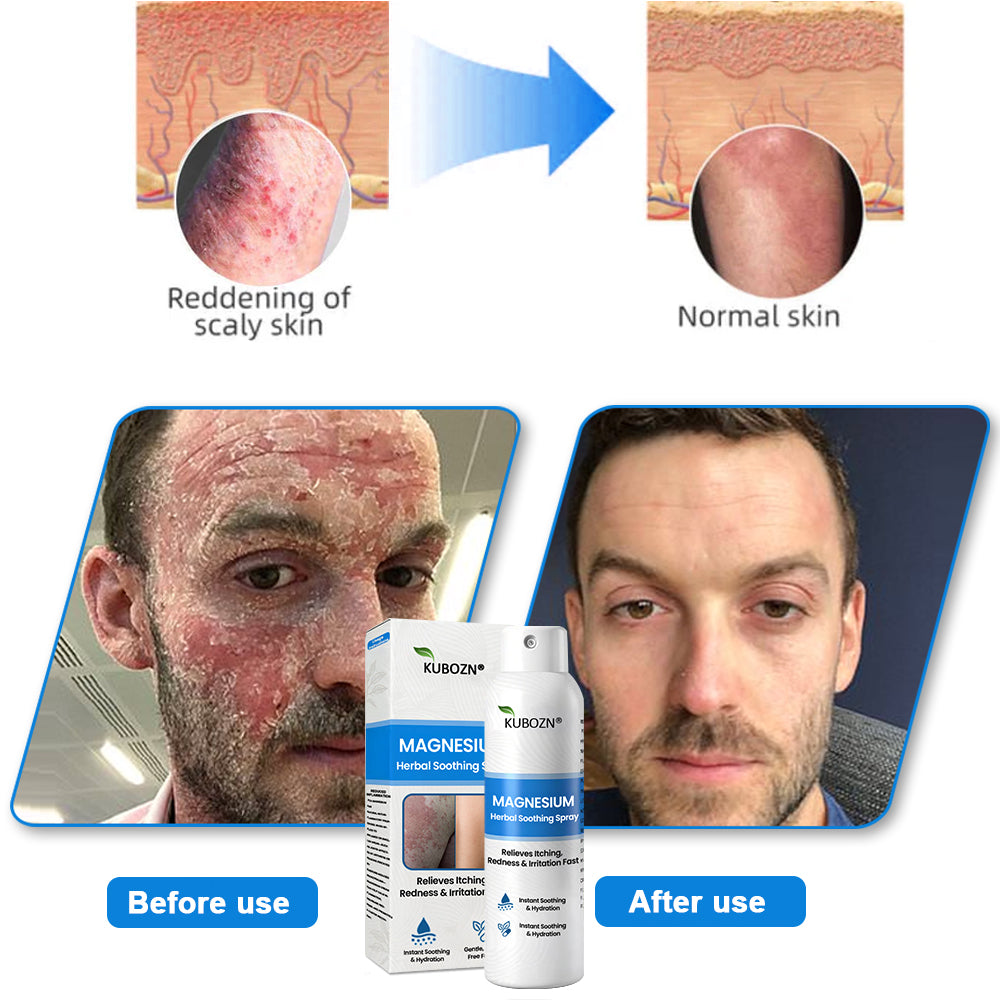 ✅ Official Store:  KUBOZN® Magnesium Herbal Psoriasis Spray 👨‍⚕️ MHRA Approved (Relieves psoriasis and eczema, improves bacterial infections in the genital area, treats acne and warts)