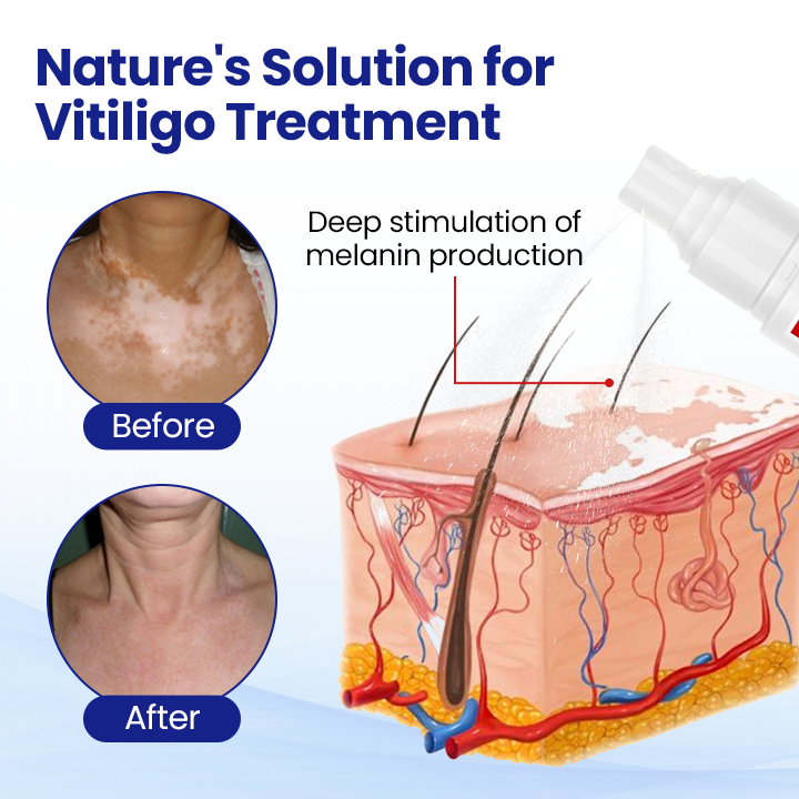 Cvreoz®Vitiligo Treatment Spray (offer)
