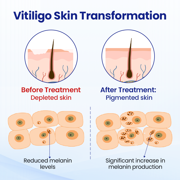 Cvreoz®Vitiligo Treatment Spray (offer)