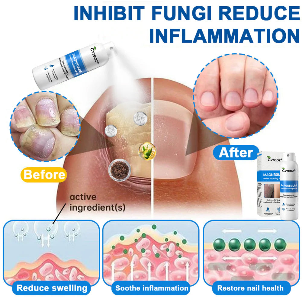 ✅ Official Store: Cvreoz® Magnesium Herbal Psoriasis Spray 👨‍⚕️ MHRA Approved (Relieves psoriasis and eczema, improves bacterial infections in the genital area, treats acne and warts)