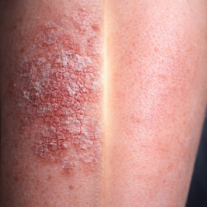 Before and after psoriasis treatment comparison