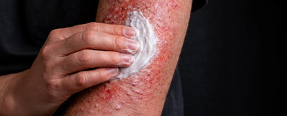 KUBOZN Tallow Spray application on psoriasis-affected skin - hero banner